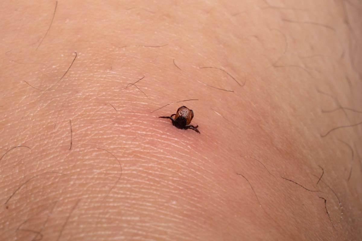 Į odą įsisiurbusi erkė